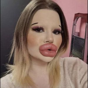 24-year-old woman wants the biggest lips in the world