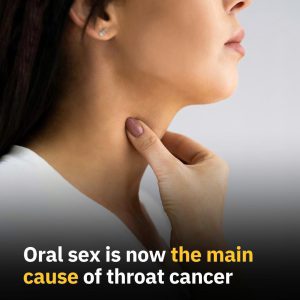 Oral x is now the main cause of throat cancer