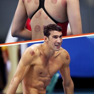 Why Were Olympic Athletes & Other Celebs Spotted with Dark Red Circles on Their Bodies?